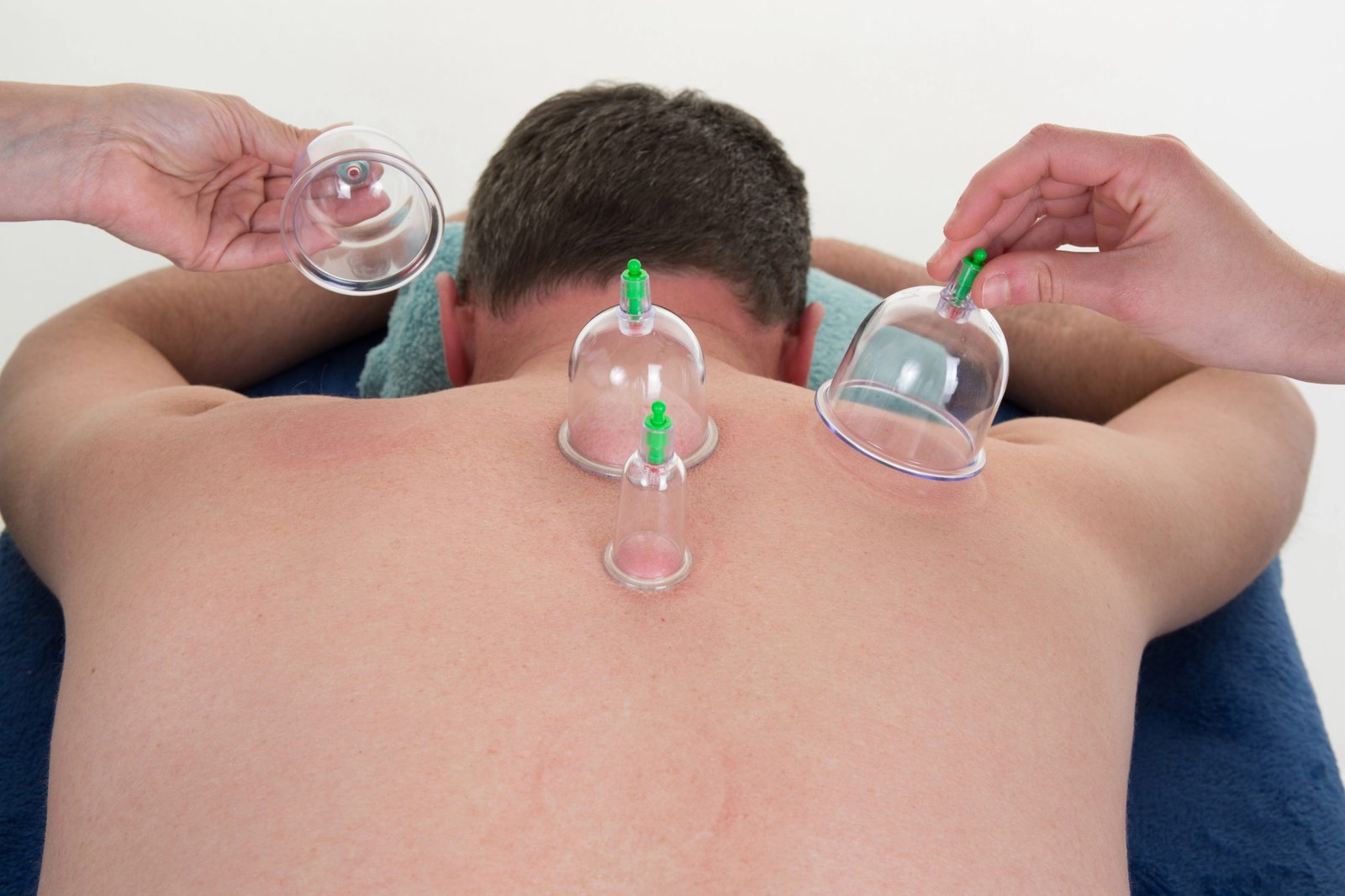moriartypt-cupping-dryneedling-painrelief-scaled moriartypt-cupping-dryneedling-painrelief-scaled
